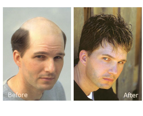 Nonsurgical Hair Replacement - Cheveux Hair Clinic